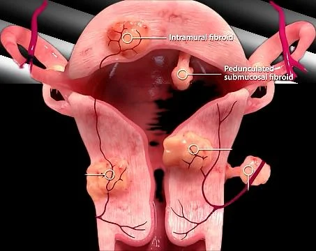 uterine fibroid embolization for large fibroids